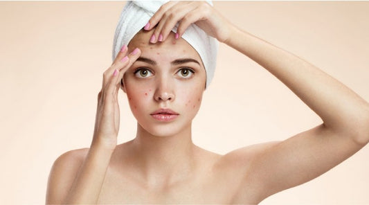 5 Hábitos que están empeorando tu acné - Raw Apothecary MX
